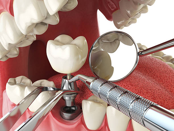 Best Emergency Root Canal Treatment in Prosperity, SC
